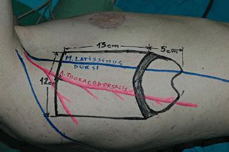 phalloplasty results 2018|Latissimus dorsi free flap phalloplasty: a systematic review.